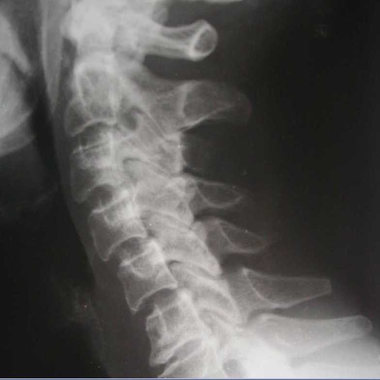 Chiropractic, X-Ray, 
